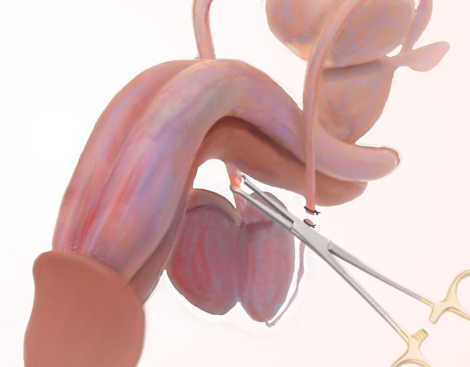лигаментотомия для павелічэння пеніса